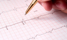 Kardiogramm nach einem Herzinfarkt