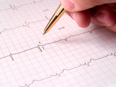 Kardiogramm nach einem Herzinfarkt